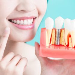 implantes dentarios